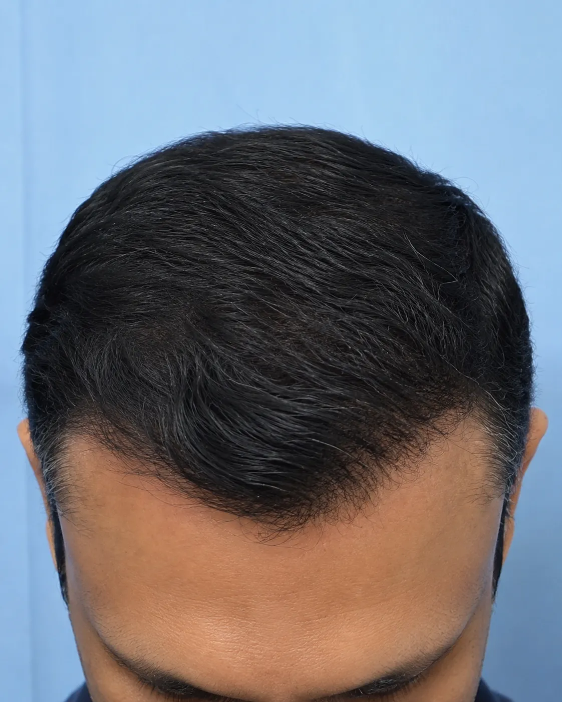 After hair transplant — reconstructed hairline and density
