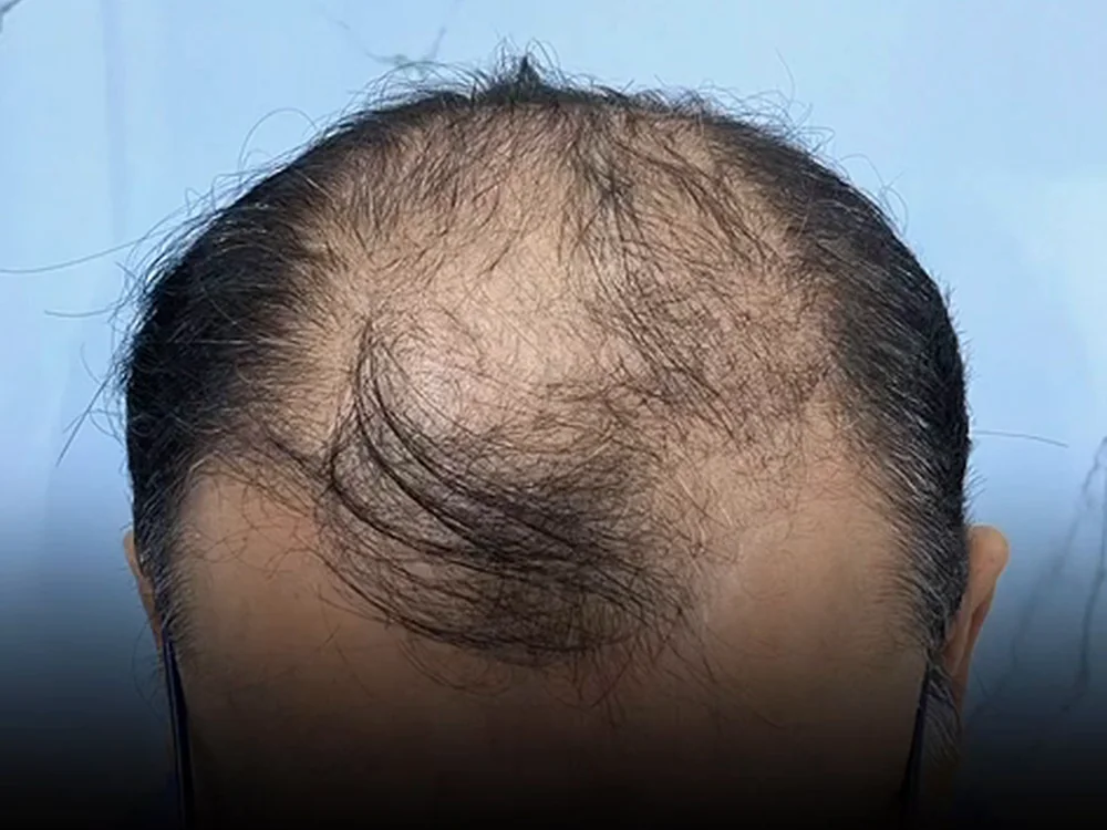 Before hair transplant — advanced thinning across the hairline and crown