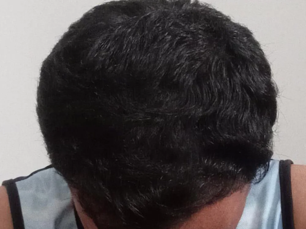 After treatment — restored density for early thinning
