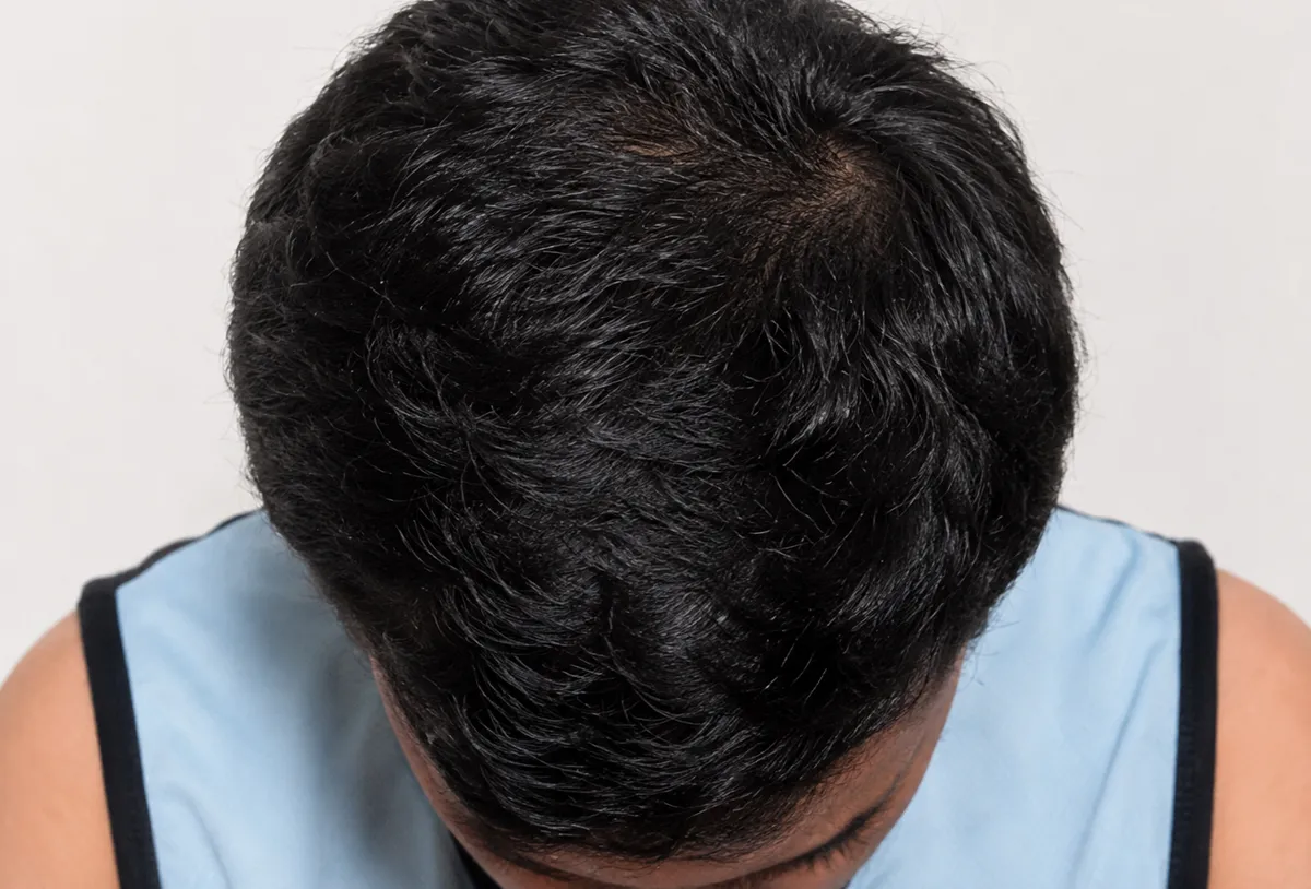Before treatment — early thinning at the crown