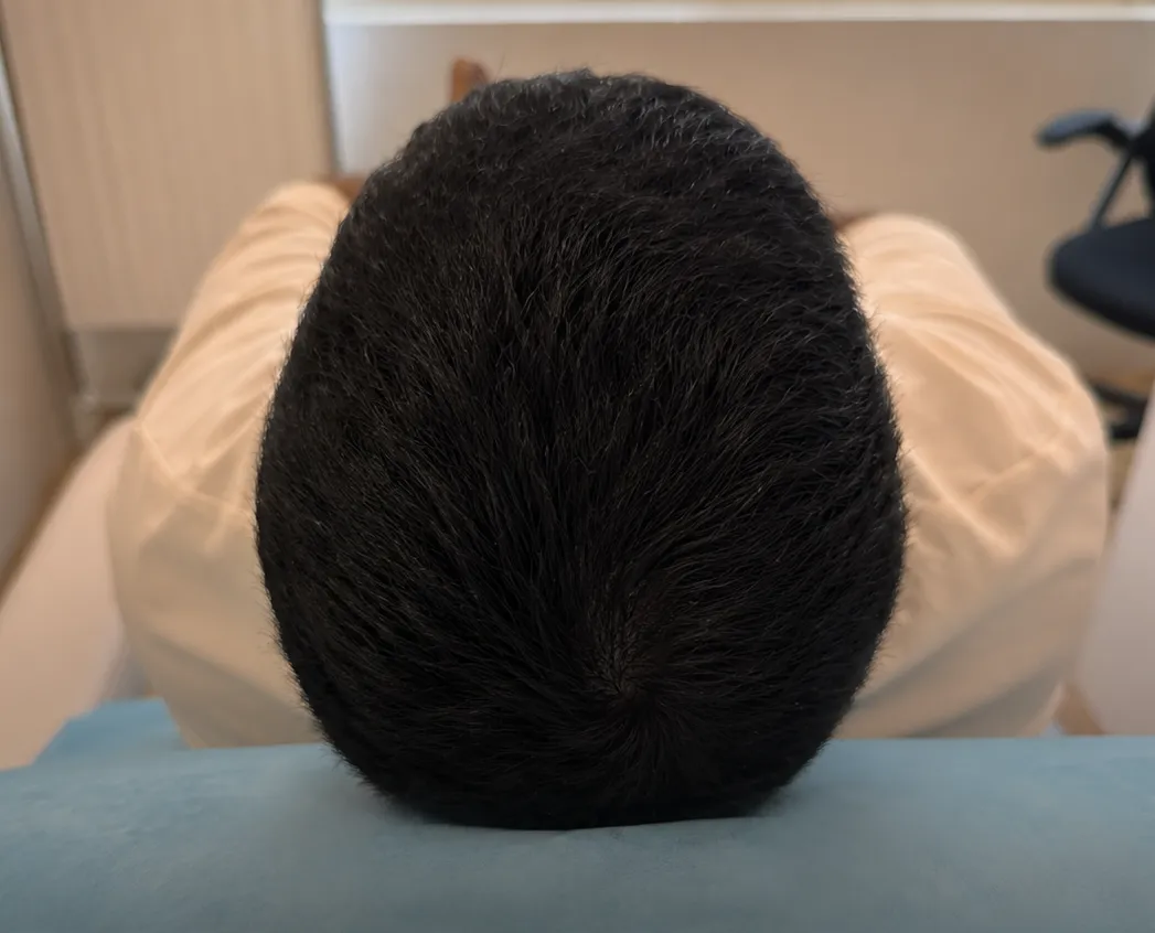 After treatment — recovered density across the crown