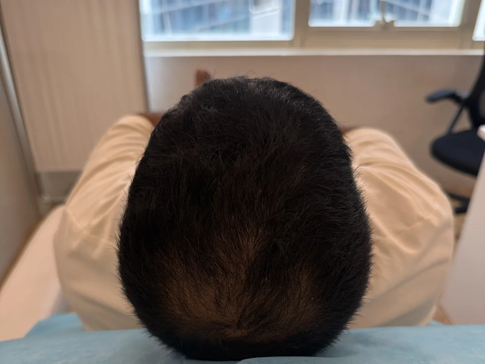 Before treatment — visible thinning and reduced density