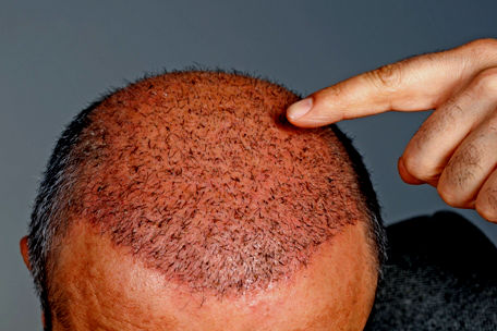 What to Expect from Your Hair Transplant?