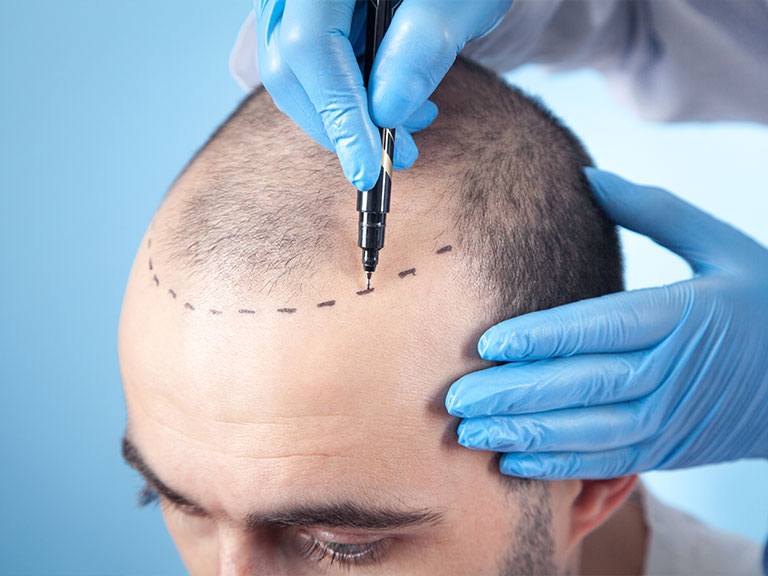hair-transplant