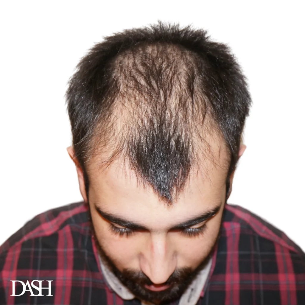 hair transplant