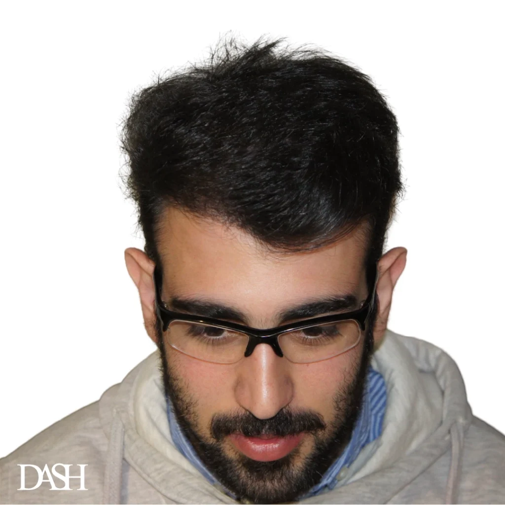 hair transplant
