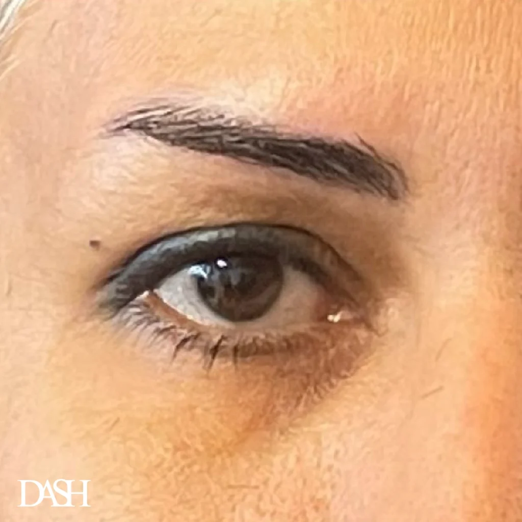 eyebrow transplant