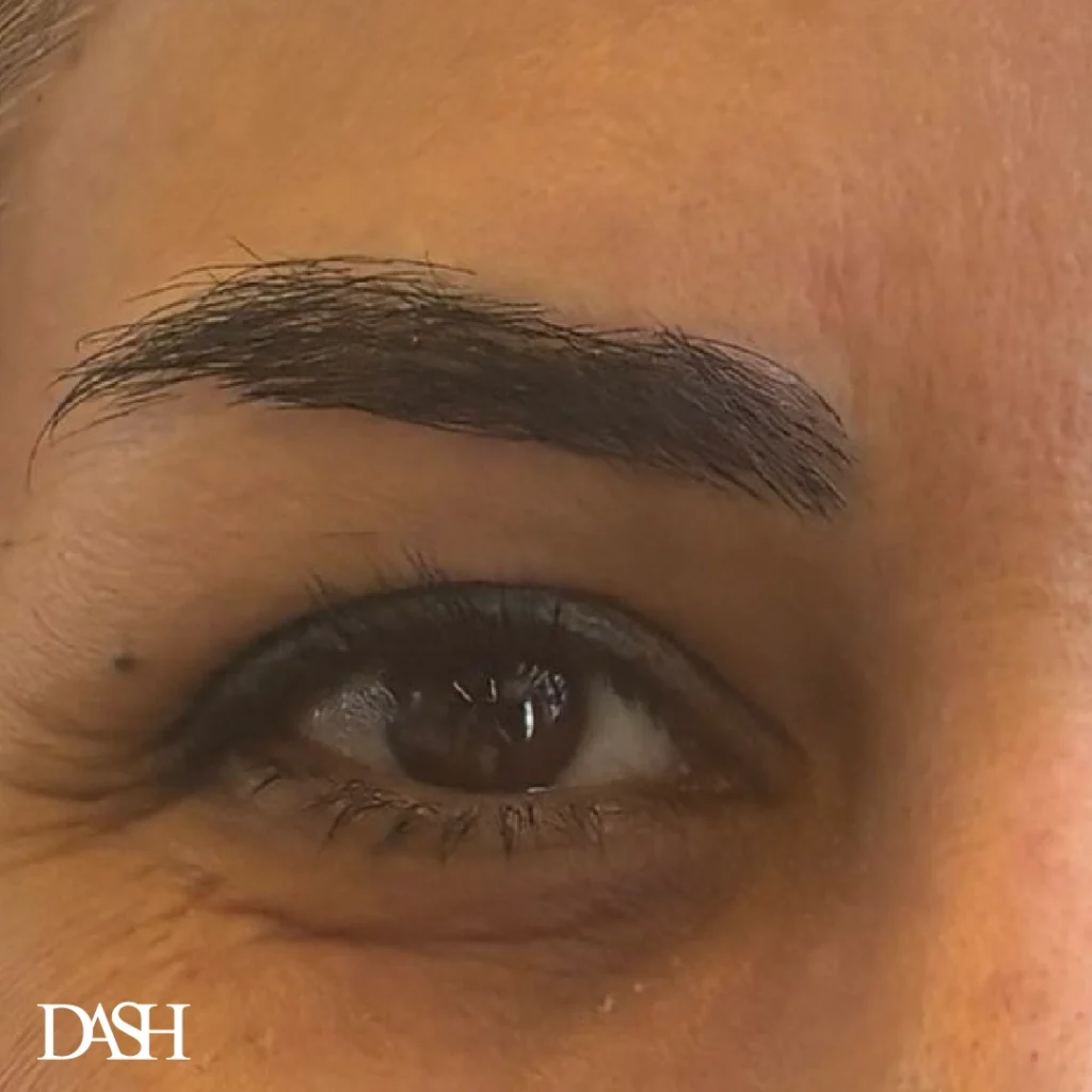 eyebrow transplant