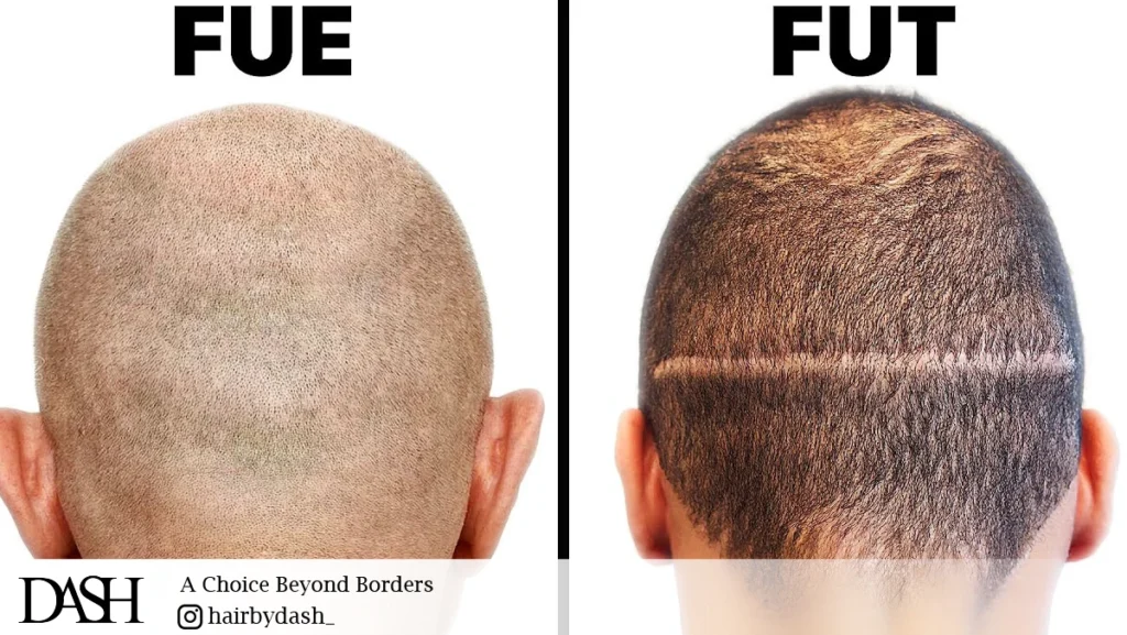 FUE vs. FUT Hair Transplant