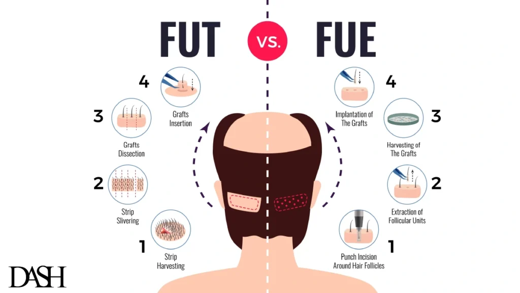 FUE and FUT Differences