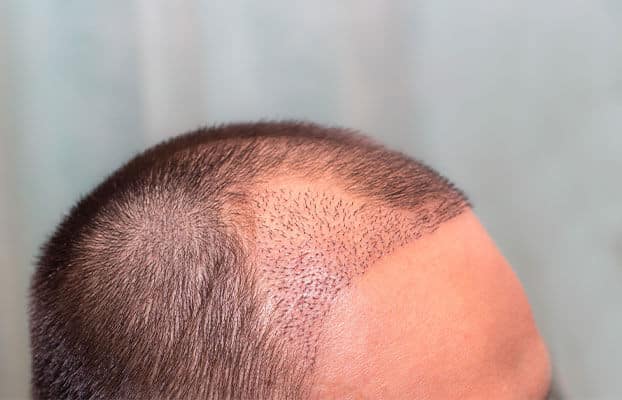 Hair Shedding After Transplant