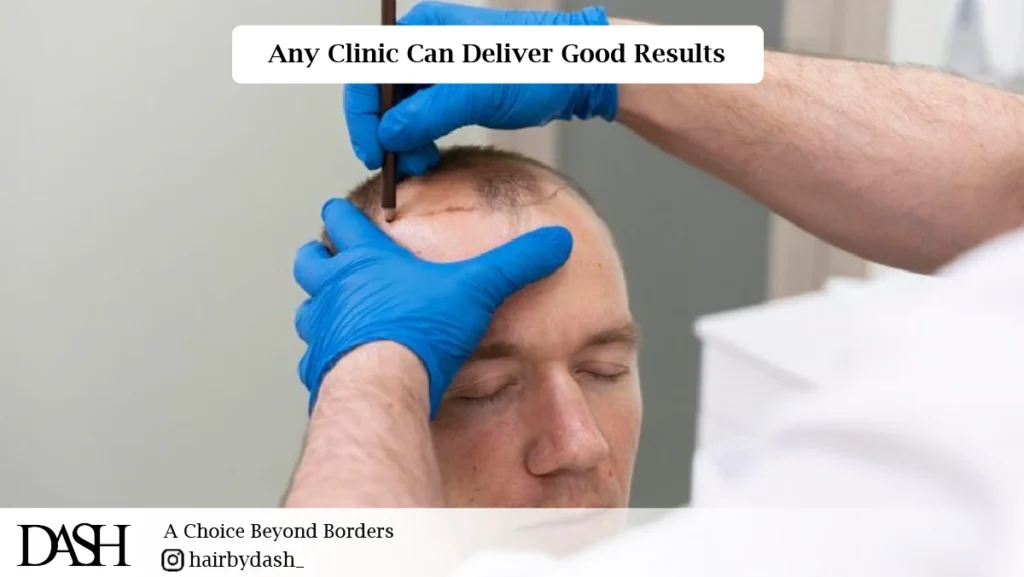 Common Myths About Hair Transplant-01