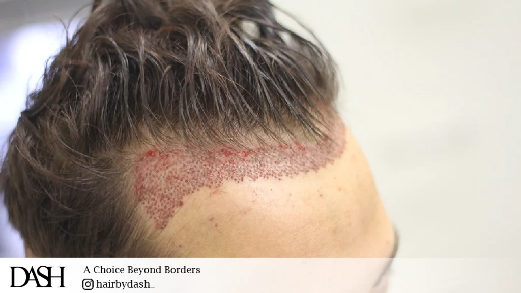 Hair Transplant for Athletes in Dubai-01