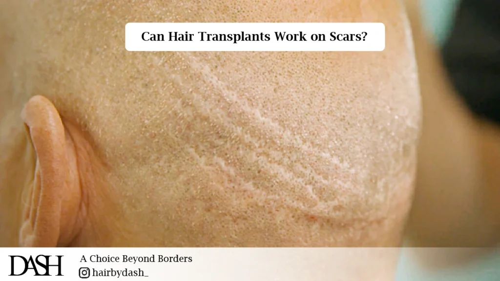 Hair Transplant for Burn and Scar Patients in Dubai-01