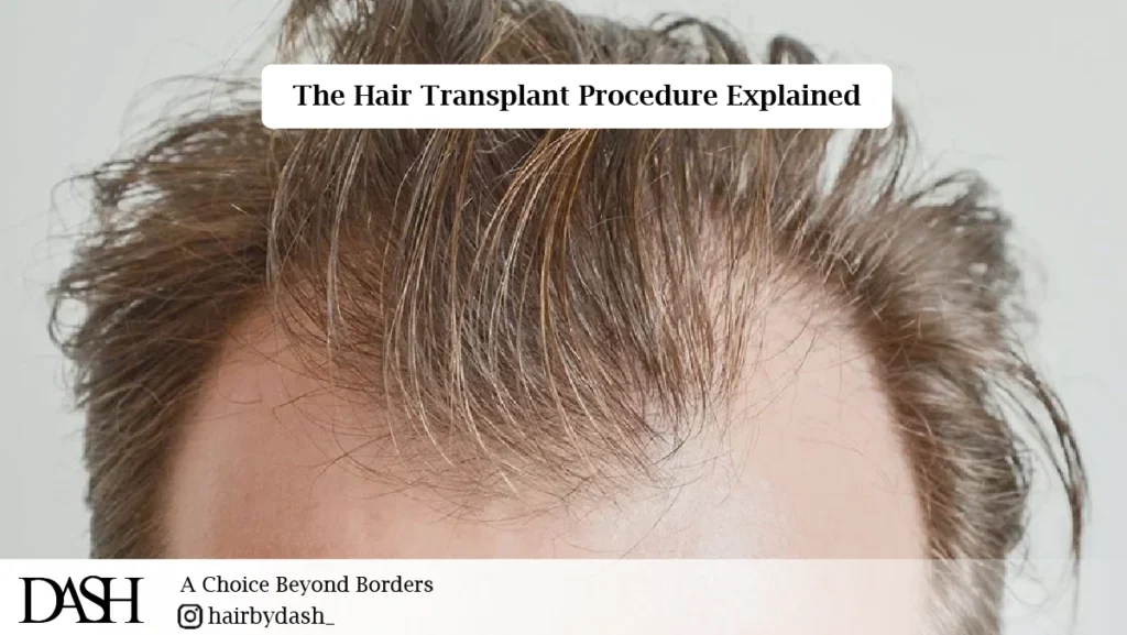 Receding Hairline Solutions-01