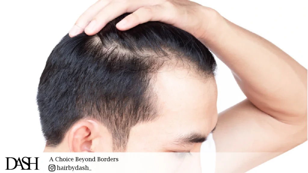 Comparing hair loss treatments surgical or non-surgical.-01