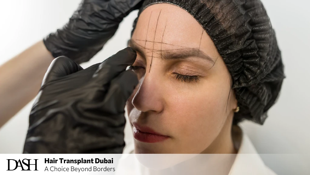 Eyebrow Transplant for Scar Coverage