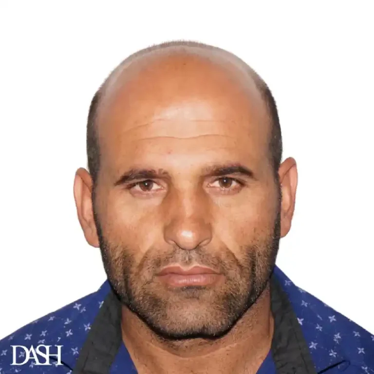 Hair Transplant in Dubai