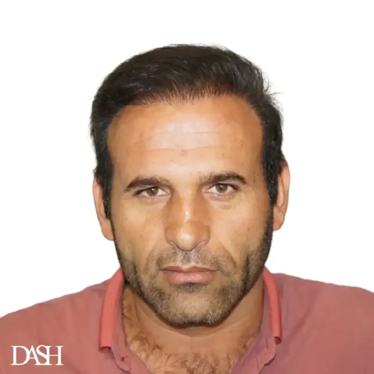 Hair Transplant in Dubai