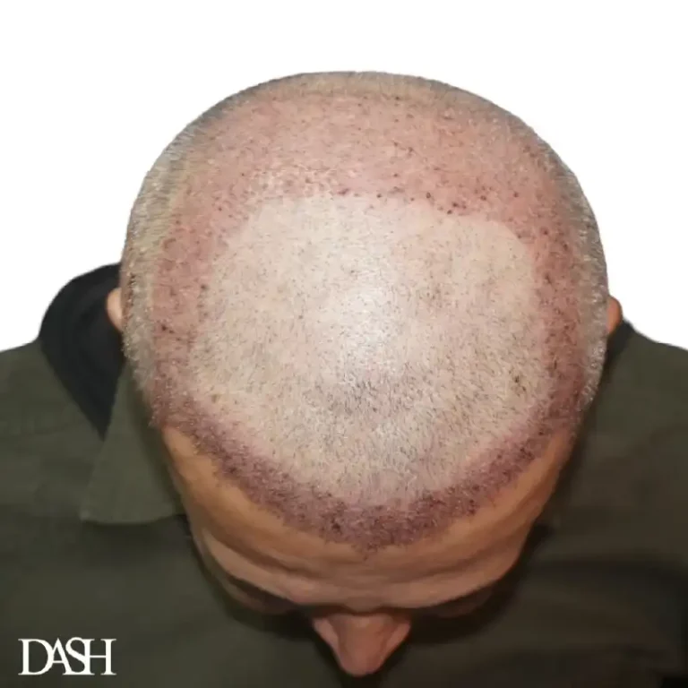 Hair Transplant in Dubai