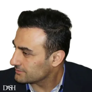 Hair Transplant in Dubai