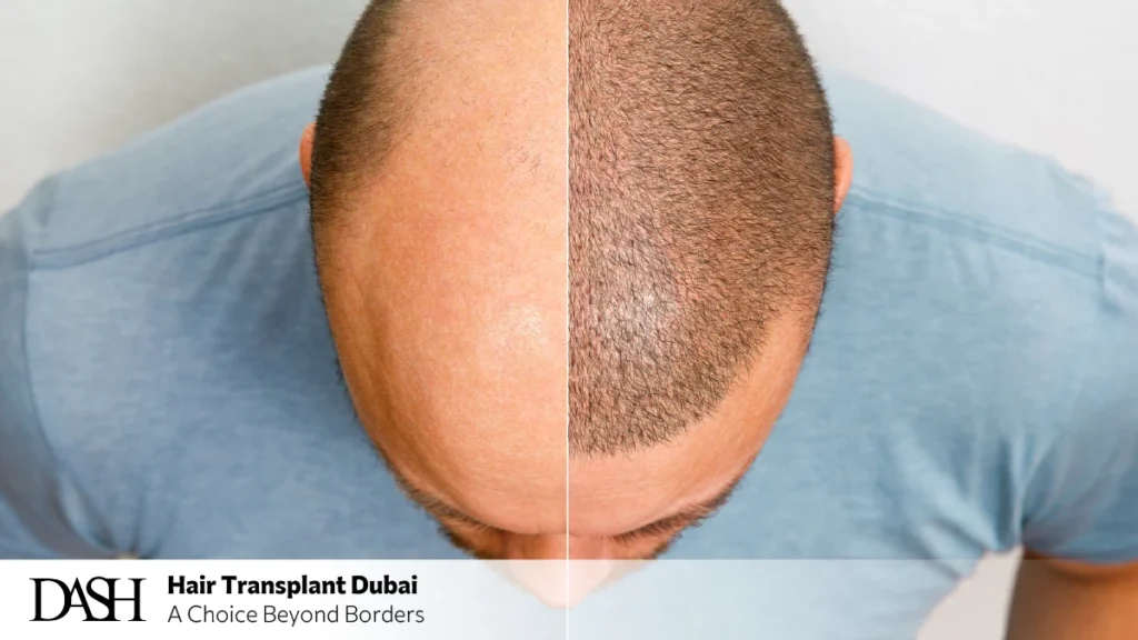 Natural Hairline Design Techniques Explained