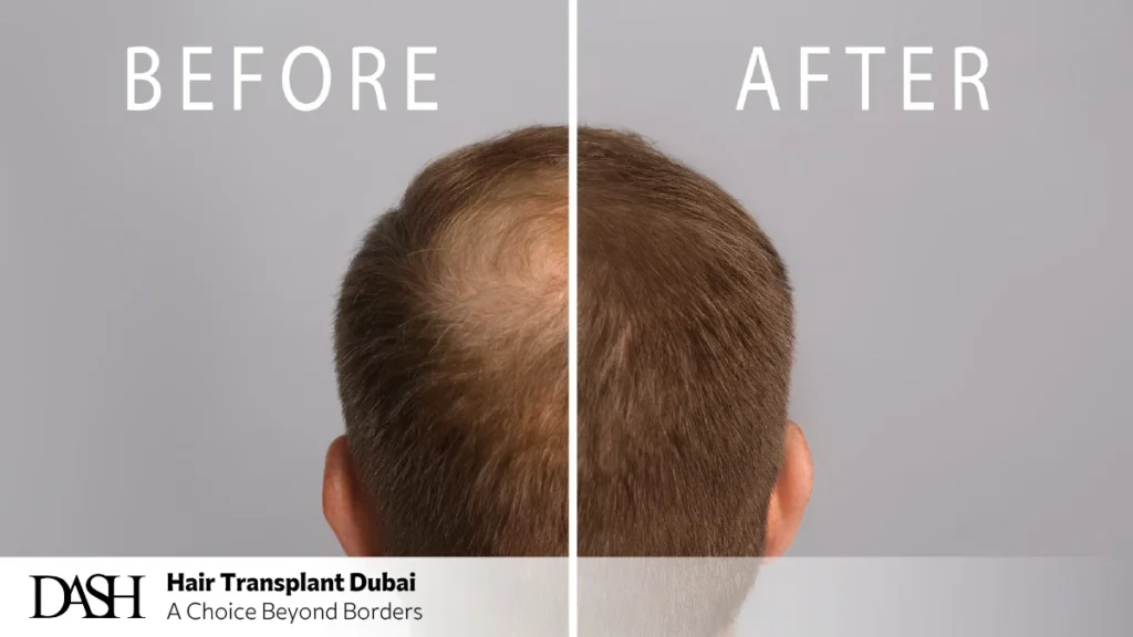 Cost of Hairline Correction in Dubai