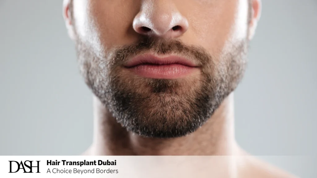 Beard Transplant Results at Dash Clinic in Dubai